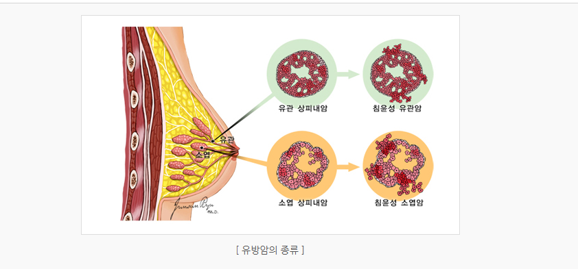 유방암34