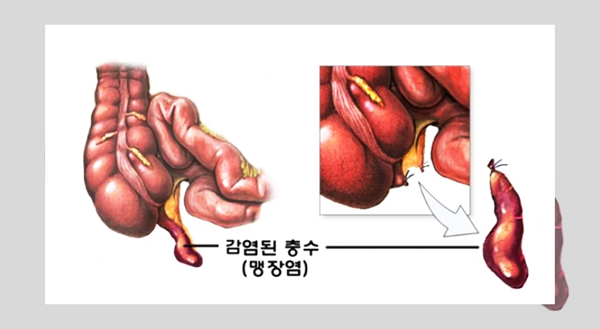 오른쪽 아랫배 통증을 유발하는 각종 질환의 증상들에 대해 안내하는 이미지로 맹장연, 대장암, 자궁질환, 난관염, 요로결석 등에 대해서 소개하고 있다