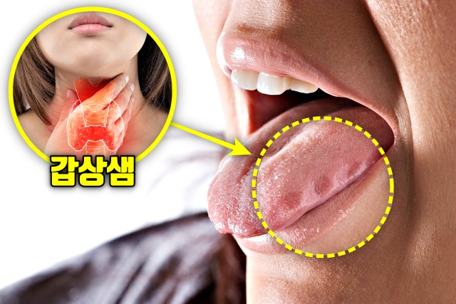 혀 가장자리가 울퉁불퉁 치흔 갑상샘 기능 저하증