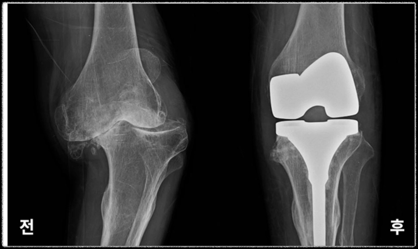 무릎인공관절수술-전-후-비교