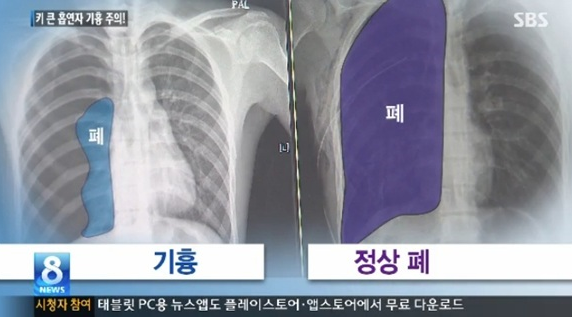  기흉 증상 자세히 알아보세요