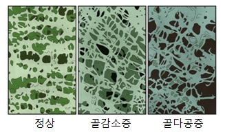 골감소증과 골다공증의 골밀도 비교