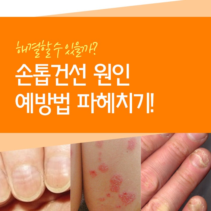 손톱