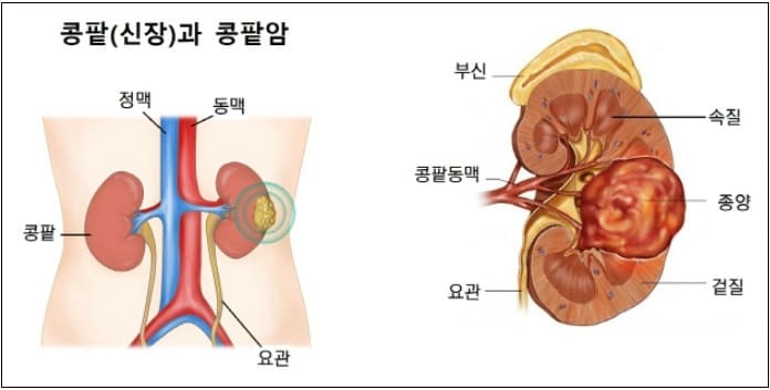  중년남성의 적 '3대 비뇨기암' Prostate cancer