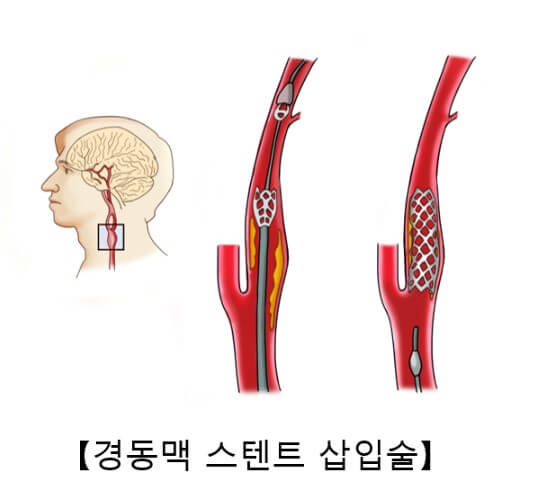경동맥 협착증