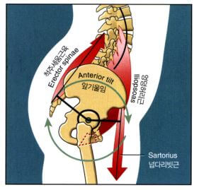 척추기립근과 봉곤근의 수축으로 골반이 전방회전 하는 그림