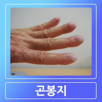 폐섬유증 초기 증상 치료법 관리방법_26