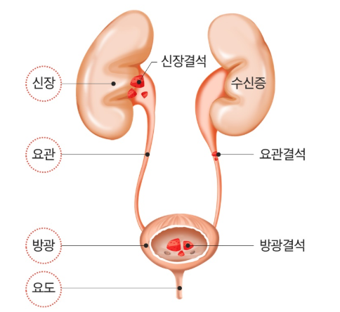 요로결석 증상 및 원인