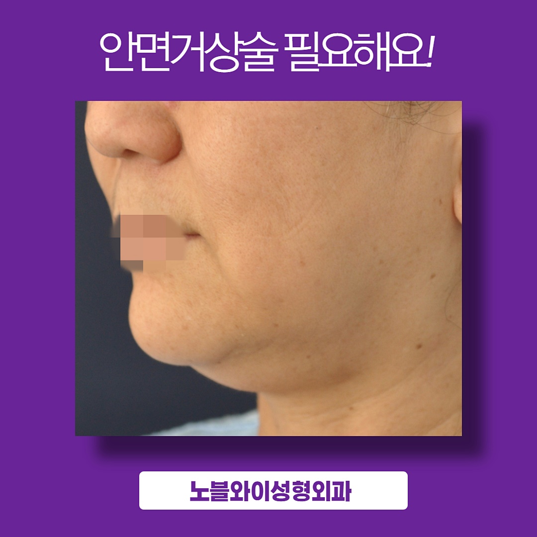  안면거상술 유지기간 속지 않으려면