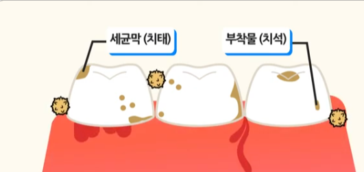치주질환(출처 : 서울대학교 의학정보)