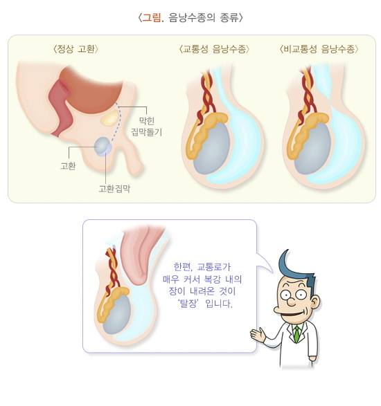  음낭수종