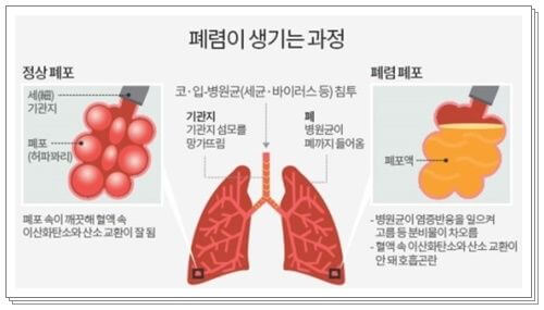 폐렴 증상