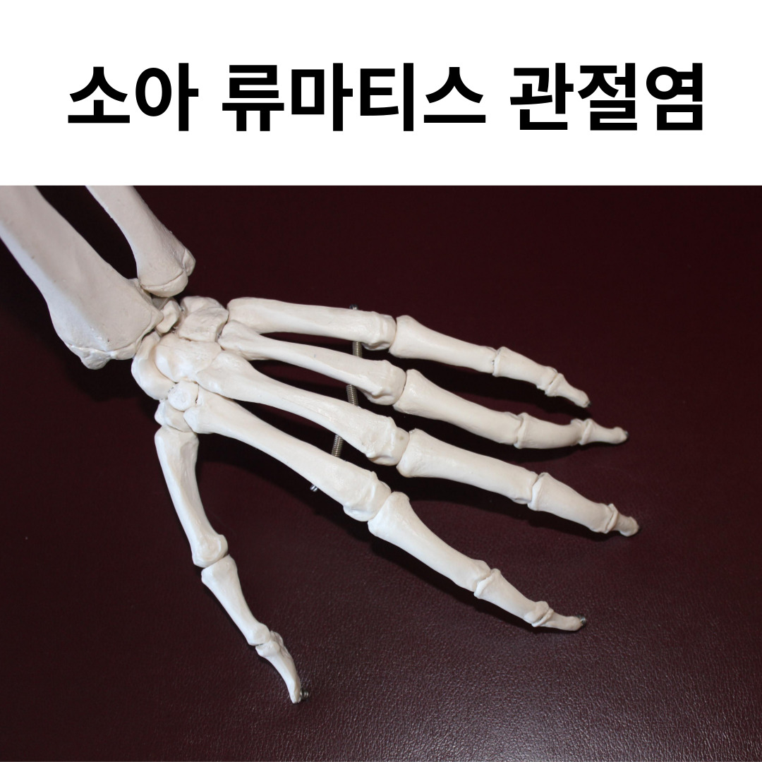 소아 류마티스 관절염