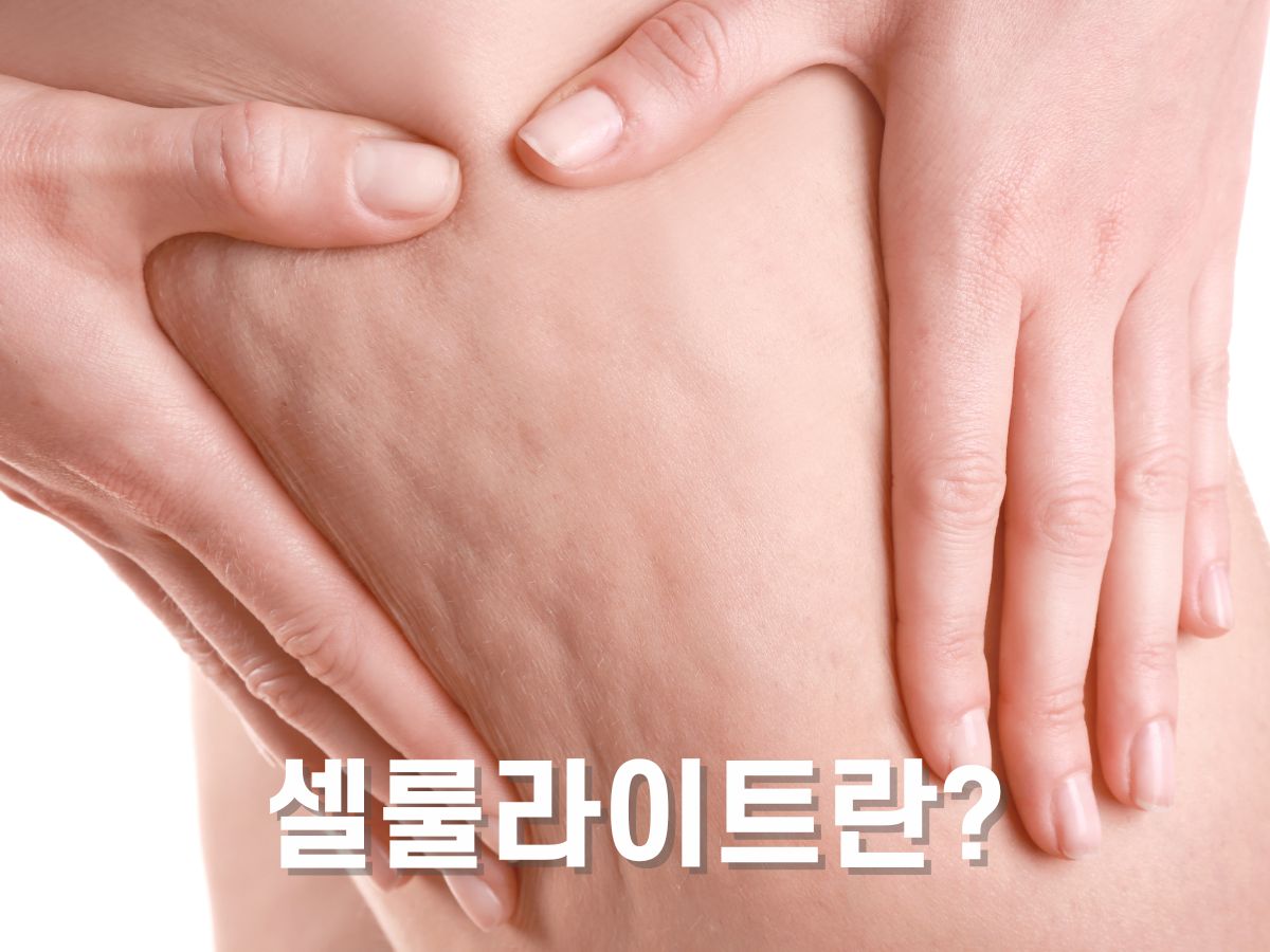 셀룰라이트란