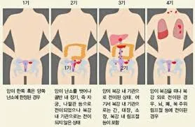 난소암 초기증상