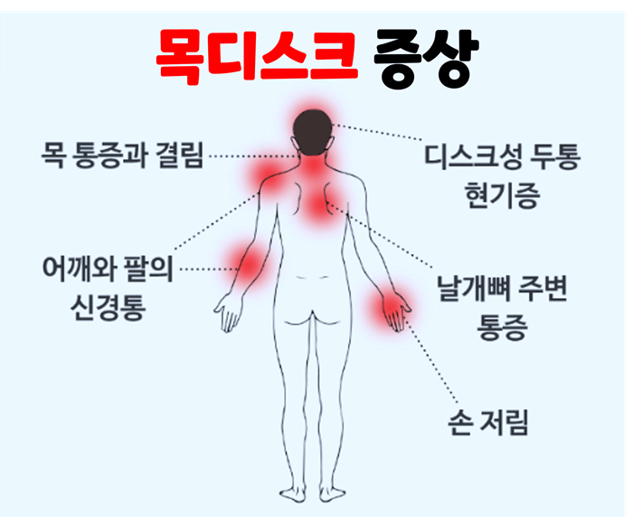 사람의 뒷모습에 목디스크로 인해 나타날 수 있는 통증 위치를 표시해놓음.
