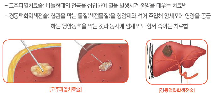  간암 초기증상 (원인 및 치료법)