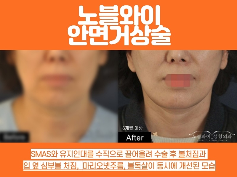  안면거상술 연예인 만큼 흉깔끔 효과좋으려면