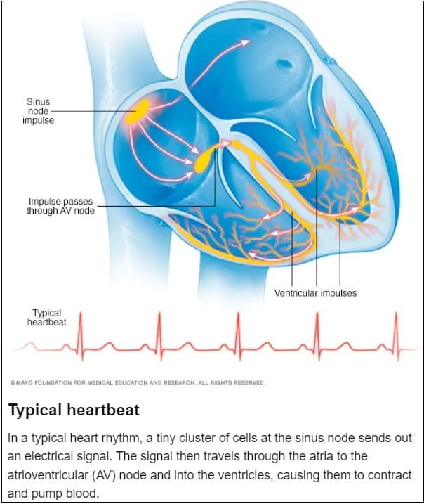 심장 부정맥(Typical heartbeat)에 대해서
