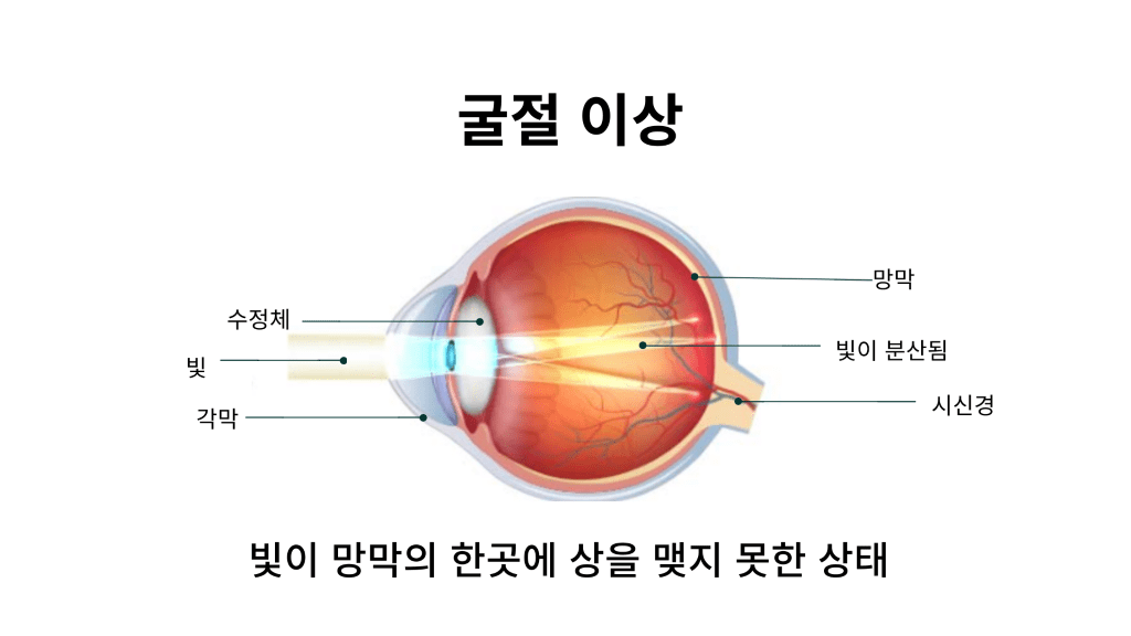 이 이미지는 눈의 내부 구조를 보여주는 단면도로, &quot;굴절 이상&quot;이라는 제목이 표시되어 있습니다. 그림에는 눈에 들어오는 빛이 각막과 수정체를 통과하며 굴절되어 망막에 도달하는 과정이 묘사되어 있습니다.