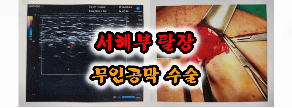 서혜부-탈장-무인공막-수술-초음파-사진