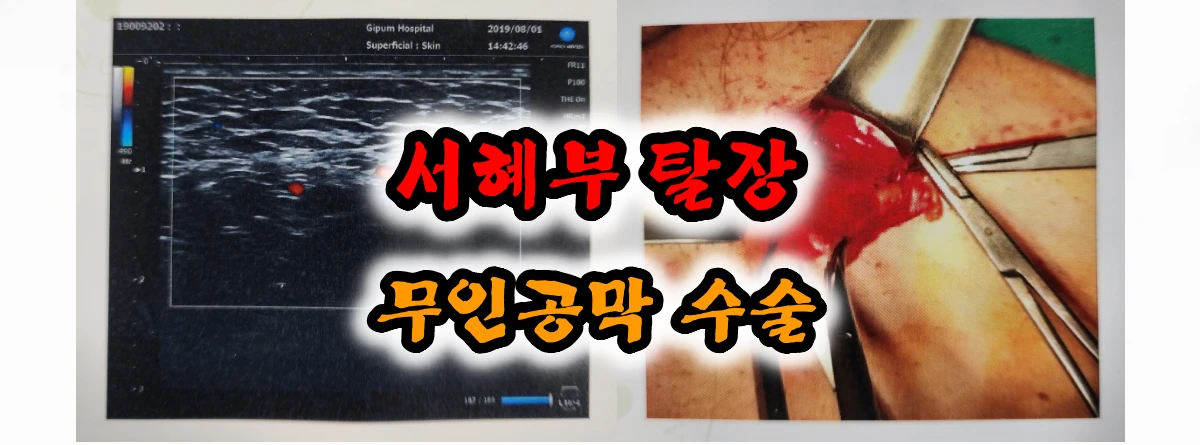  서혜부 탈장 무인공망 수술 전문 병원