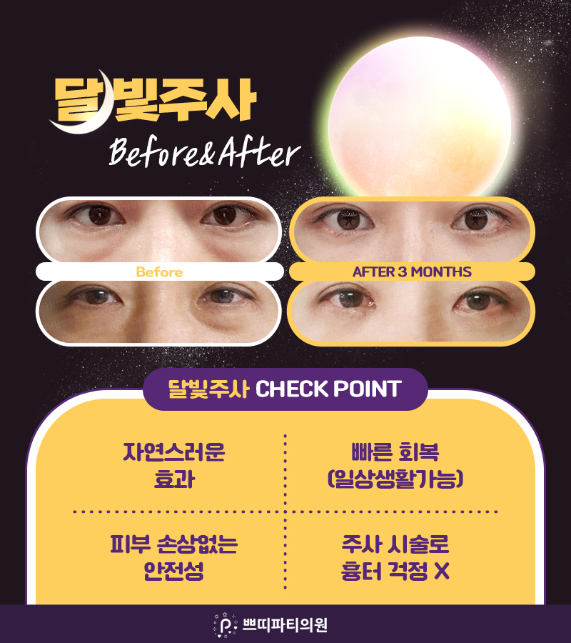  다크서클주사 눈밑콜라겐주사로 다크서클 개선하는 방법
