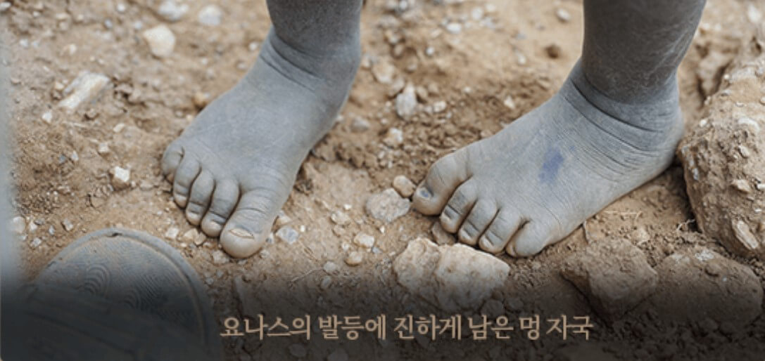 아이의 멍든 발등