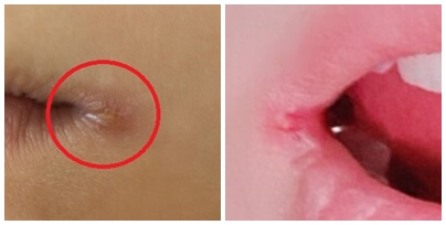 헤르페스 감기 염증