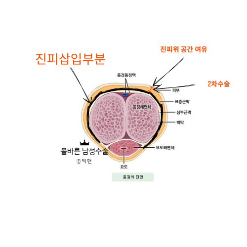 남성 대체진피 확대수술 요즘 너무 잘못알고 계신분들이 많아서 정리해드립니다. - 닥터유 비뇨기과 빅맨