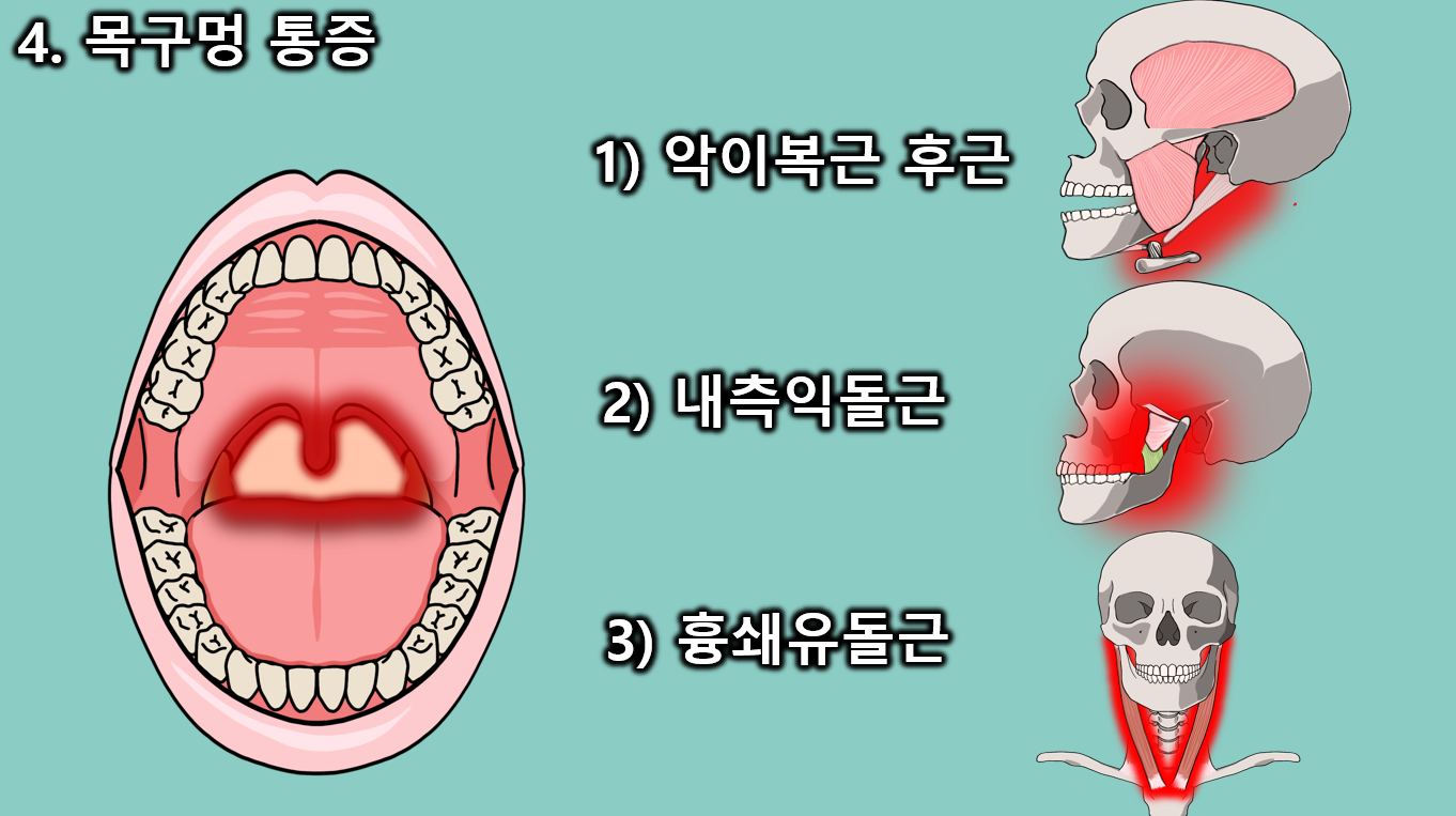 턱관절 근육통 통증유발점과 이비인후과 증상 총정리