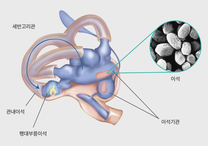 이석증