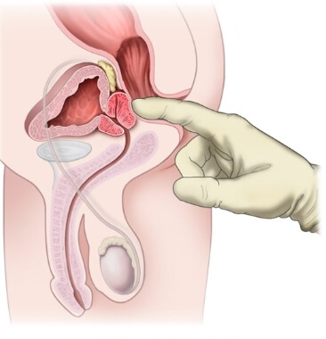 전립선비대증 검사 방법