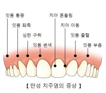  치주염 증상 및 치료법