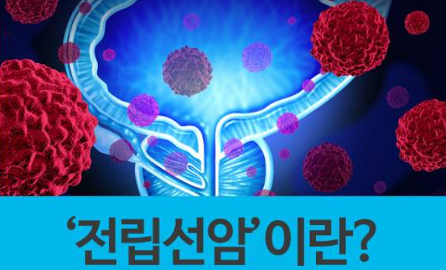 전립선암 PSA수치확인으로 초기에 진단을 14