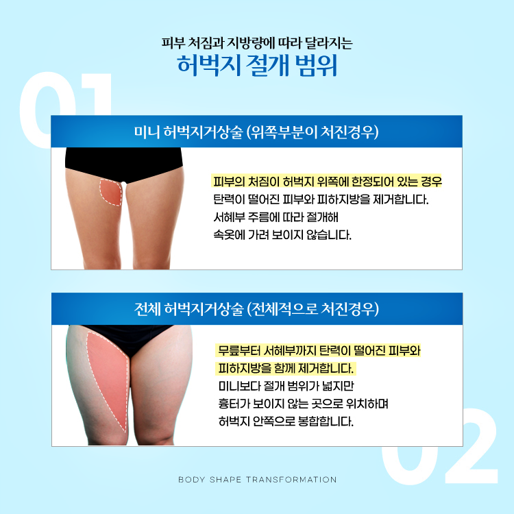 피부처짐과 지방량에 따라서 달라지는 허벅지 절개 부위 
1. 미니 허벅지 거상술 (위쪽부분이 처진경우)
2. 전체 허벅지 거상술 (전체적으로 처진경우)