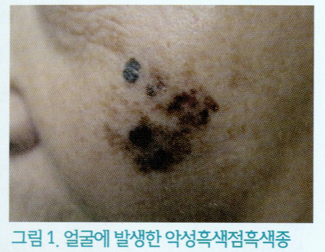  악성흑색종의 모든 것 / 피부암 / 흑색종 / 흑색종 자가진단 / 흑색종 치료