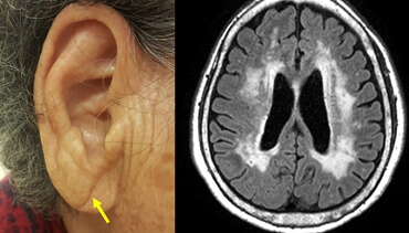 귓불 주름과 뇌 MRI 사진