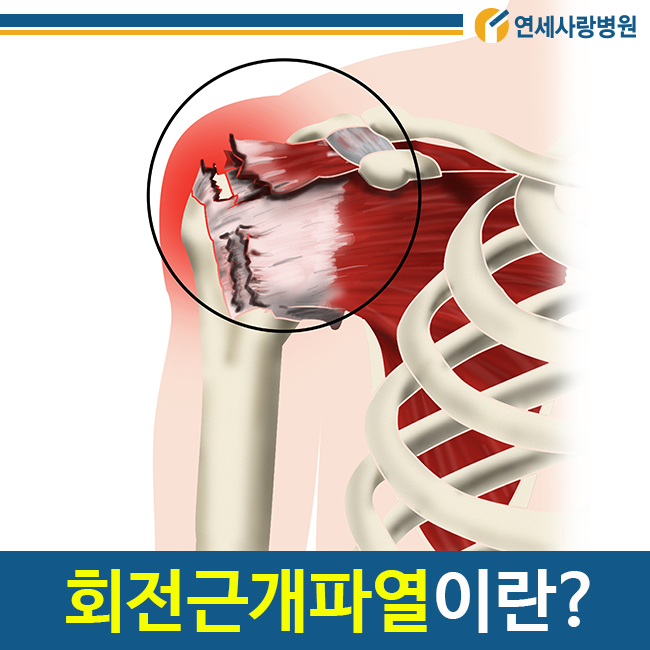 오른쪽 어깨 통증, 회전근개파열 증상과 원인, 수술 치료(재활 병원, 운동 방법) 3