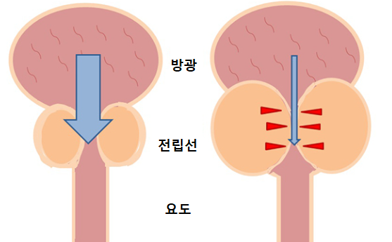  전립선 비대증 원인과 증상 및 치료방법