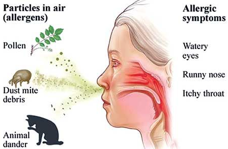코비염 : 알레르기 비염 증상 원인 (출처 : Pinterest)