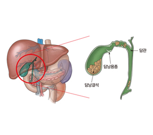 간문부 담관암(클라츠킨 종양)의 증상 원인 치료 예방 방법 식사 요법 추천 음식 식단 극복