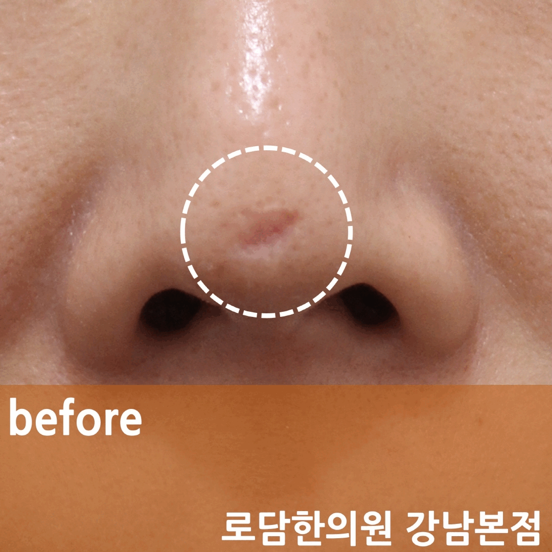  코끝 하이코 패인 흉터 치료 과정 새살침 코라테라피