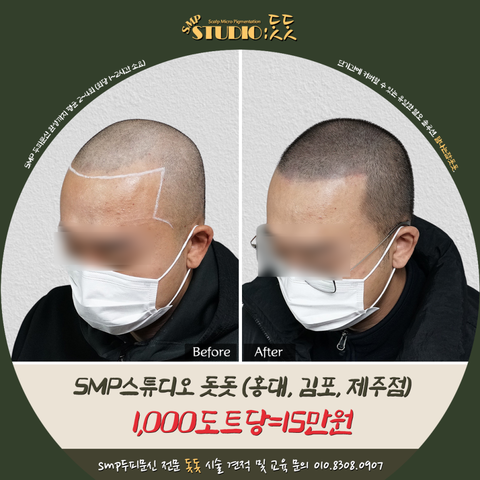  두피문신 가격 1천도트당 15만원