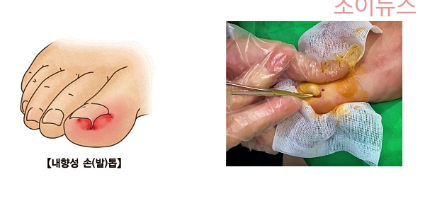내향성 손발톱