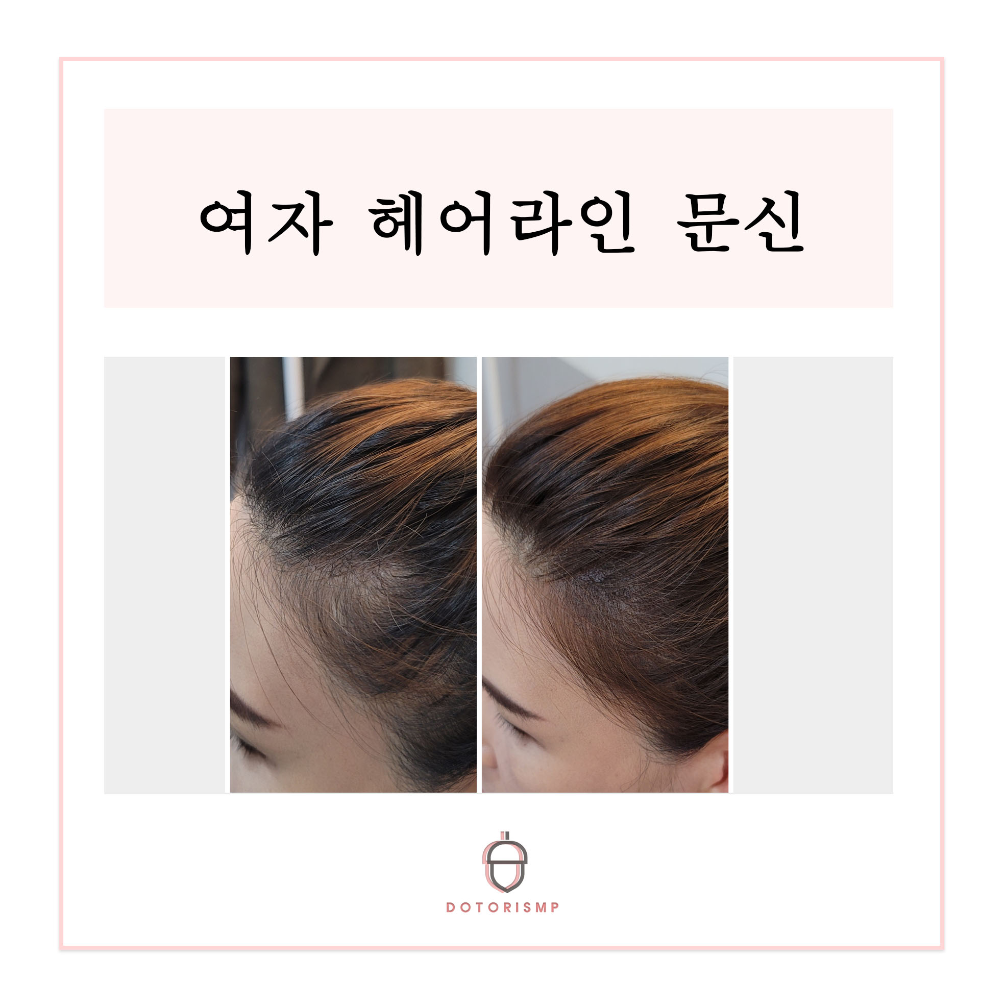  관리 필요없는 부산 헤어라인 두피문신 후기 공개합니다.
