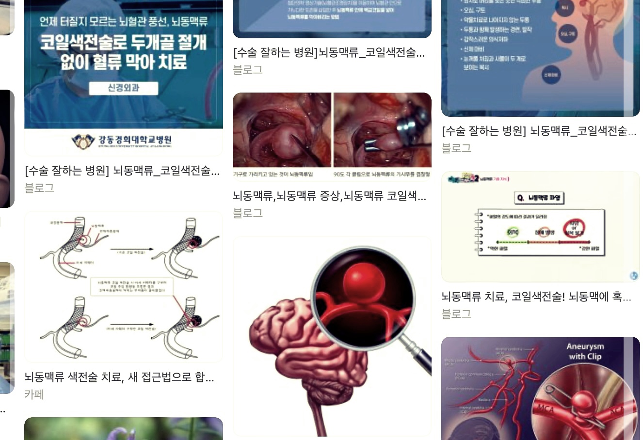 뇌동맥류 코일 색전술 비용 및 수술후기.