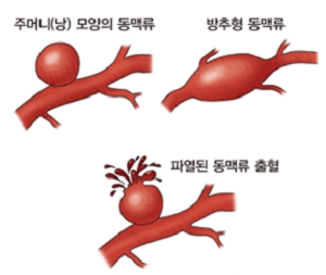 대동맥류 주머니 및 동맥파열