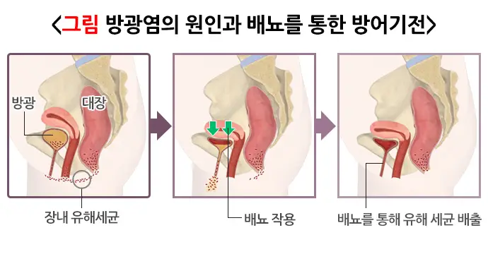 방광염의 원인과 배뇨를 통한 방어기전 그림