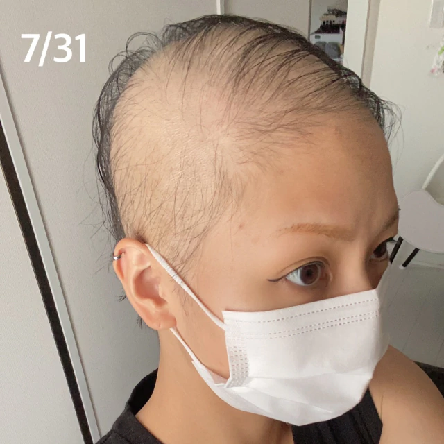 모더나 백신 접종 후 탈모 부작용